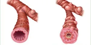 Polusi Udara dan Ancaman Tersembunyi, Waspadai Gejala Bronkitis pada Si Kecil!