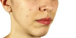 Rutin Gunakan Masker Tomat dan Madu untuk Wajah Cerah Bebas Flek Hitam