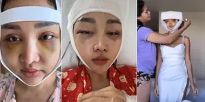 11 Potret Penampakan Wajah Lucinta Luna Usai Oplas dan Sebelum Di-Unboxing, Bengkak dan Memar Sampai Susah Makan