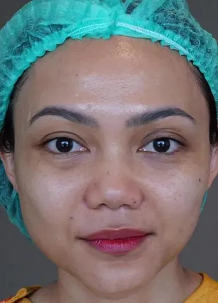 8 Potret Perjalanan Rina Nose Oplas Hidung, Tunjukan Perubahan Hari ke Hari