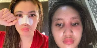 11 Artis Indonesia yang Jadi Korban Efek Samping Treatment Kecantikan, Ada yang Hidungnya Membusuk