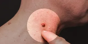 8 Cara Menghilangkan Kutil  di Tubuh dengan Pengobatan Rumahan Alami