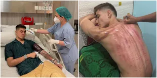 Aisar Khaled Jalani Kerokan Sepulang dari Rumah Sakit, Begini Kondisinya