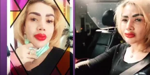 Bibir Bengkak Parah Usai Sulam Warna, Penampilan Barbie Kumalasari Jadi Begini