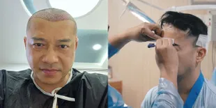 Bukan Cuma Anang Hermansyah, Sederet Seleb Ini Juga Pernah Jalani Transplantasi Rambut - Hasilnya Curi Perhatian