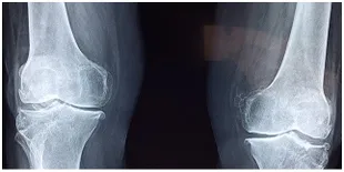 Cara Menjaga Kesehatan Tulang Agar Tidak Mudah Keropos