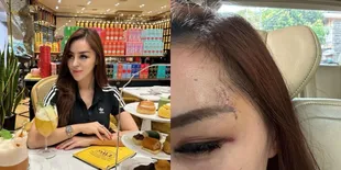 Gara-gara Utang, Selebgram Safa Marwah Harus Dioperasi Karena Pelipis Mata Sobek Dipukuli Pacar