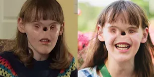 Inspiratif! Gadis Tanpa Hidung dan Mata Ini Tetap Hidup Normal