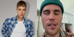 Justin Bieber Alami Kelumpuhan Wajah Karena Sindrom Ramsay Hunt, Terpaksa Batalkan Konser