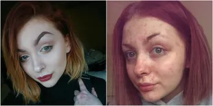 Kena Psoriasis, Cewek Ini Diputusin Pacar Saat Hapus Make Up