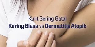 Kulit Eksim Butuh Pelembap yang Tepat, Ini Tips Memilihnya
