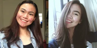 Berjerawat, Gadis Ini Sebar Pesan Positif Tentang Inner Beauty