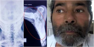 Seorang Pasien Buat Dokter Terkejut Saat Temukan 75 Paku di Tubuh