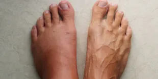 Solusi Ampuh untuk Kaki Bengkak: Temukan Penyebab, Pengobatan, dan Tips Pencegahannya!