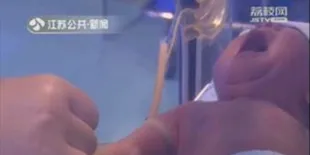 Tak Sengaja Terbelit Sehelai Rambut, Jari Bayi Ini Hampir Putus