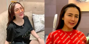 Ucie Sucita Makin Pede Usai Tutupi Jidat Jenong dengan Transplantasi Rambut