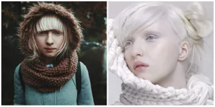 8 Potret Nastya Zhidkova, Model Albino Dengan Mata Indah