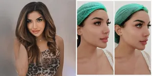 8 Prosedur Kecantikan yang Dilakukan Millen Cyrus: Filler, Suntik Pemutih, Sampai Bulu Mata Extension