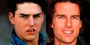 8 Selebriti Ini Rombak Giginya Biar Lebih Rapi, Siapa Aja Ya?