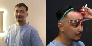 Alami Kebotakan Sampai Krisis Percaya Diri, Intip Potret Dimas Aditya Jalani Transplantasi Rambut 