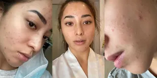 Dikenal Cantik Paripurna, Ini Potret Nikita Willy Ketika Wajahnya Berjerawat Hingga Sempat Merasa Minder