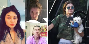 FOTO: Tak Selamanya Mulus, Wajah Artis-Artis Ini Juga Jerawatan