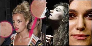 [Foto] Terungkap! Wajah Seleb Hollywood Ini Dipenuhi Jerawat