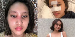 Infeksi Akibat Oplas, 16 Potret Kronologi Permesta Dhyaz Anak Farida Nurhan Alami Bengkak di Hidung - Kini Implan Dilepas