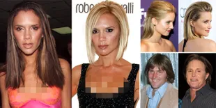 Inilah Penampakan Before - After Seleb Dunia Yang Operasi Plastik