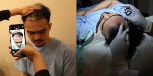 Mengintip Proses Hair Transplantation di Kai Aesthetic Clinic, Pakai Teknik Baru dengan Tingkat Keberhasilan 98%