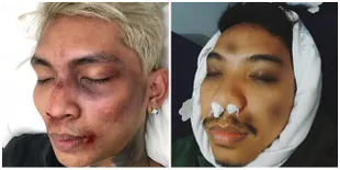 Netizen Bikin Challenge Make Up Babak Belur Young Lex, Hasilnya?