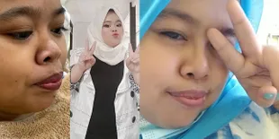 Potret Kekeyi Lakukan Filler Hidung, Hasilnya Bikin Melongo - Banjir Hujatan Netizen