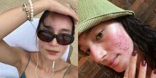 Potret Tatjana Saphira Percaya Diri Pamer Bare Face Dengan Muka Berjerawat, Akui Butuh 10 Tahun Untuk Sembuh