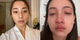 Ada Lesti Hingga Nikita Willy, 10 Artis Cantik Ini Tetap Percaya Diri Pamer Wajah Penuh Jerawat