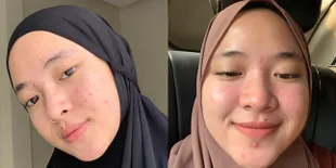 Wajahnya Disorot Netizen, Ini 8 Potret Nissa Sabyan Jerawatan dan Tanpa Make Up: Jerawat Kehamilan?