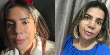 7 Potret Nowela Idol Pasca Kena Cacar, Wajah Penuh Bekas - Sebut Tak Mulus Lagi