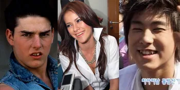 7 Selebritis Ini Melakukan Operasi Gigi