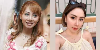 9 Transformasi Artis Sebelum dan Sesudah Filler Dagu, Wajah Makin Tirus dan Bikin Pangling