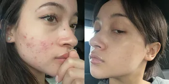 Acne Fighter! 8 Potret Megan Domani Perlihatkan Wajah Berjerawat - Akui Dulu Takut Kena Cibir sampai Nggak Mau Keluar Rumah