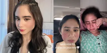 Cerita Tissa Biani Jadi Acne Fighter Selama 4 Tahun, Sempat Malu Bertemu Orang - Kini Berhasil Melewatinya
