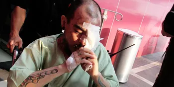 Iritasi Mata, Beery Saint Loco Tak Alami Kebutaan