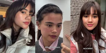Perawatan 42 Juta Rupiah di Korea, Ini Before - After Wajah Audi Marissa
