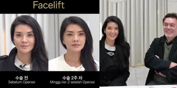 Putuskan Lakukan Operasi Plastik, Perubahan Wajah Farah Quinn Kini Jadi Lebih Terlihat Muda