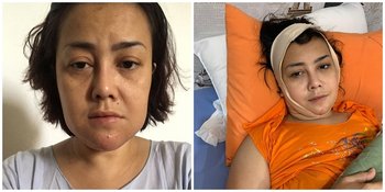 5 Potret Rency Milano yang Alami Malpraktik Klinik Kesehatan, Dagu Sampai Keluarkan Nanah