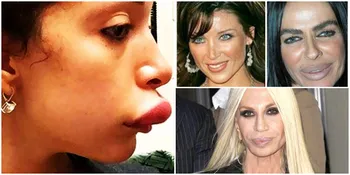 Ngeri! Oplas, Selebritis Ini Alami Perubahan Bibir Mengejutkan