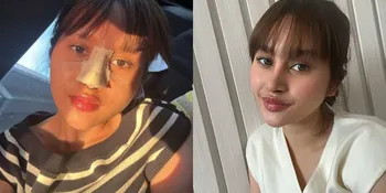 Nggak Kapok, Potret Permesta Dhyaz Anak Farida Nurhan Oplas Hidung Lagi
