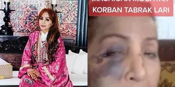 Potret Machica Mochtar Setelah Jadi Korban Tabrak Lari Sopir Angkot, Wajah Lebam-Lebam Membiru