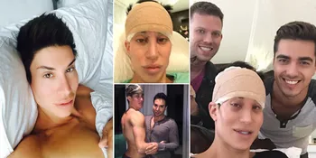 Potret Oplas Justin Jedlica, Dari Persiapan Hingga Wajah Bengkak