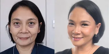 Potret Wajah Dian Nitami Setelah Sebulan Operasi Face Lifting, Puas Kulitnya Terasa Kencang dan Hasilnya Natural