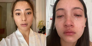 Ada Lesti Hingga Nikita Willy, 10 Artis Cantik Ini Tetap Percaya Diri Pamer Wajah Penuh Jerawat